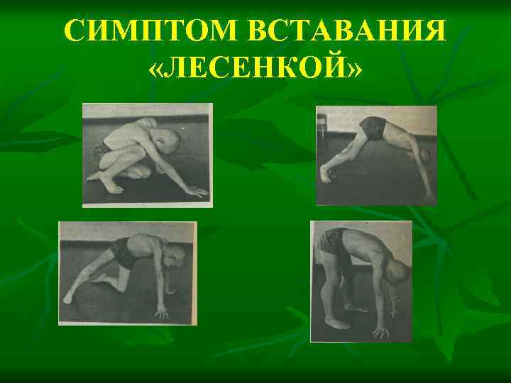 СИМПТОМ ВСТАВАНИЯ «ЛЕСЕНКОЙ» 