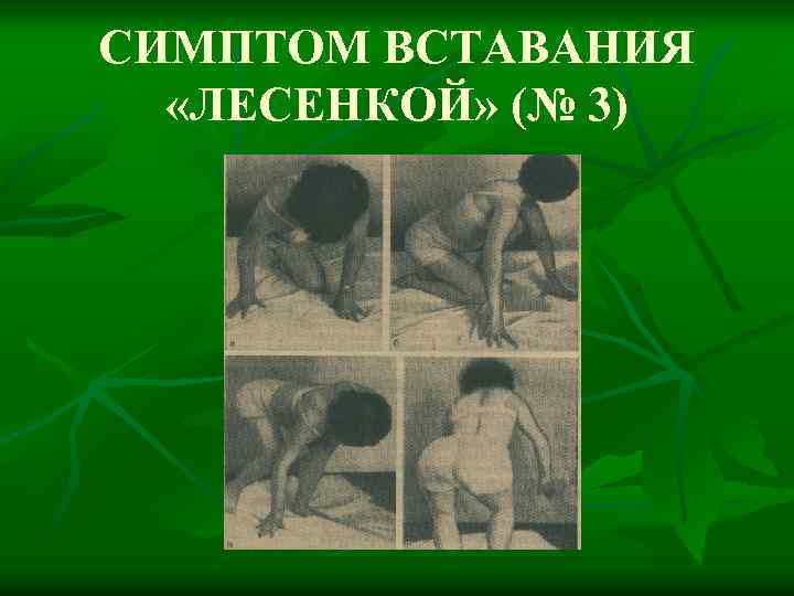 СИМПТОМ ВСТАВАНИЯ «ЛЕСЕНКОЙ» (№ 3) 