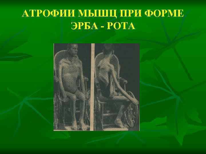 АТРОФИИ МЫШЦ ПРИ ФОРМЕ ЭРБА - РОТА 