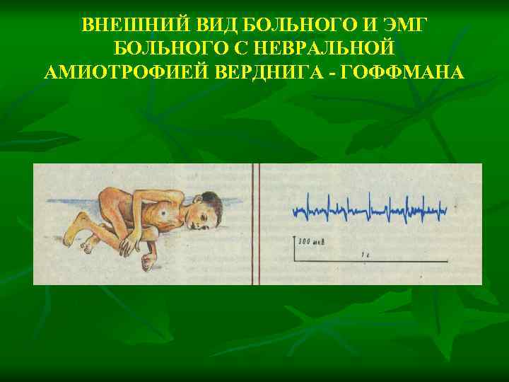 ВНЕШНИЙ ВИД БОЛЬНОГО И ЭМГ БОЛЬНОГО С НЕВРАЛЬНОЙ АМИОТРОФИЕЙ ВЕРДНИГА - ГОФФМАНА 