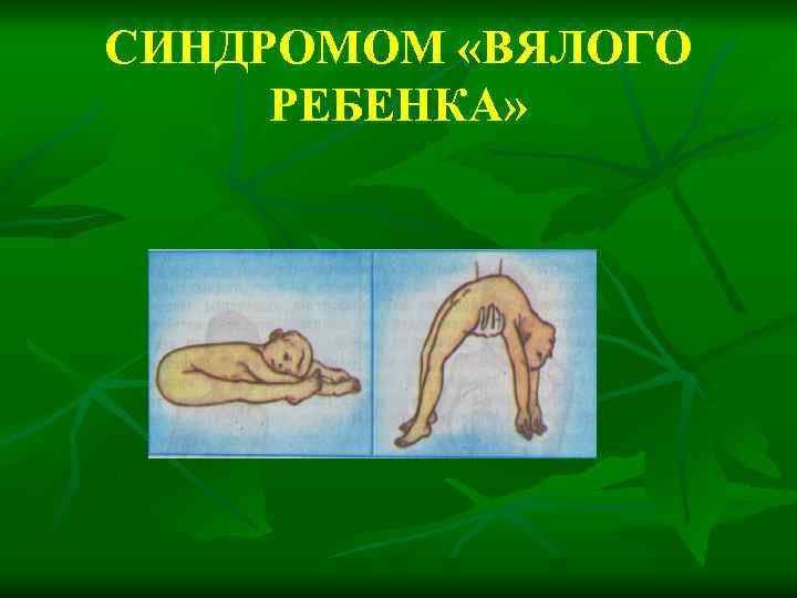 СИНДРОМОМ «ВЯЛОГО РЕБЕНКА» 