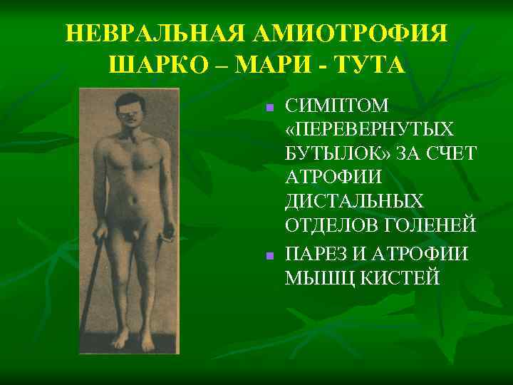 НЕВРАЛЬНАЯ АМИОТРОФИЯ ШАРКО – МАРИ - ТУТА n n СИМПТОМ «ПЕРЕВЕРНУТЫХ БУТЫЛОК» ЗА СЧЕТ