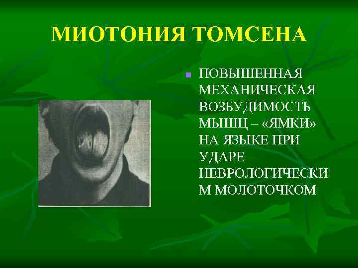 МИОТОНИЯ ТОМСЕНА n ПОВЫШЕННАЯ МЕХАНИЧЕСКАЯ ВОЗБУДИМОСТЬ МЫШЦ – «ЯМКИ» НА ЯЗЫКЕ ПРИ УДАРЕ НЕВРОЛОГИЧЕСКИ