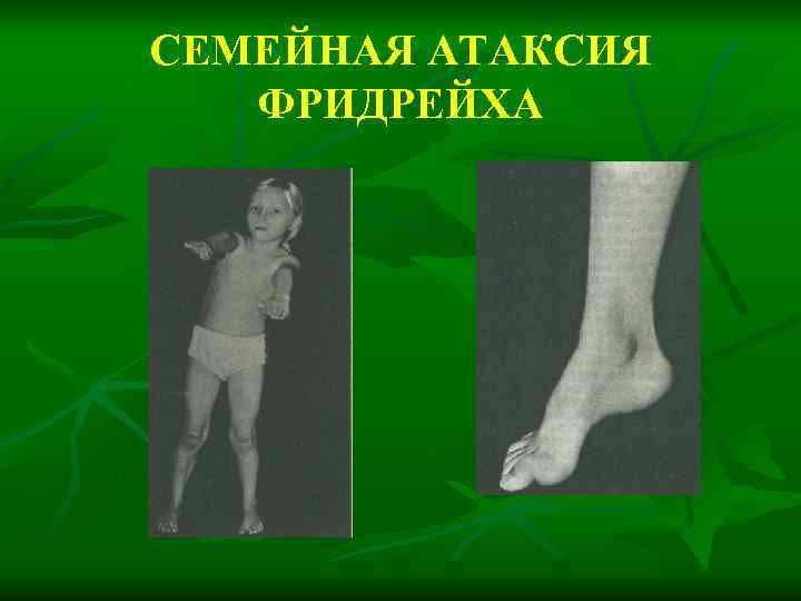 СЕМЕЙНАЯ АТАКСИЯ ФРИДРЕЙХА 