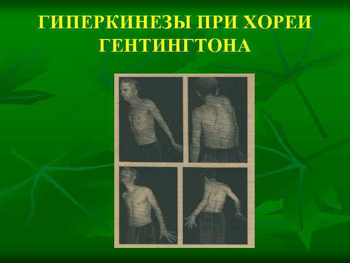 ГИПЕРКИНЕЗЫ ПРИ ХОРЕИ ГЕНТИНГТОНА 