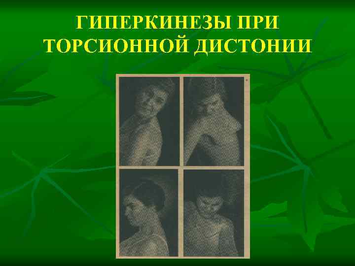 ГИПЕРКИНЕЗЫ ПРИ ТОРСИОННОЙ ДИСТОНИИ 