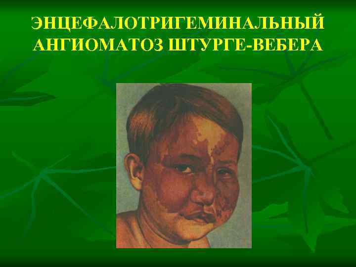 ЭНЦЕФАЛОТРИГЕМИНАЛЬНЫЙ АНГИОМАТОЗ ШТУРГЕ-ВЕБЕРА 