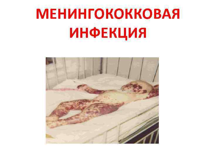 МЕНИНГОКОККОВАЯ ИНФЕКЦИЯ 