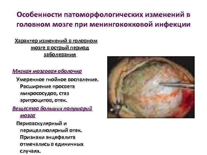Особенности патоморфологических изменений в головном мозге при менингококковой инфекции Характер изменений в головном мозге
