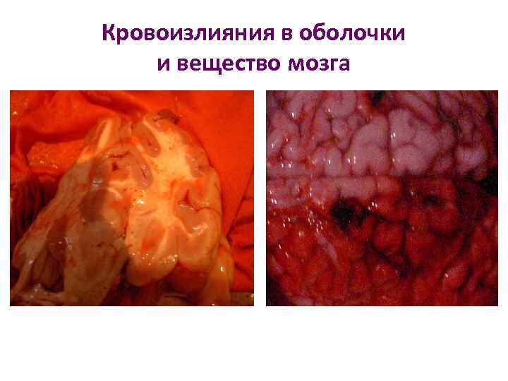 Кровоизлияния в оболочки и вещество мозга 