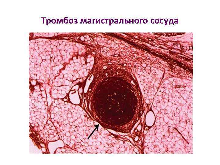 Тромбоз магистрального сосуда 