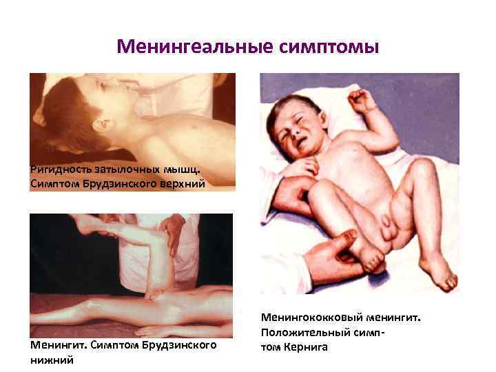 Менингеальные симптомы Ригидность затылочных мышц. Симптом Брудзинского верхний Менингит. Симптом Брудзинского нижний Менингококковый менингит.