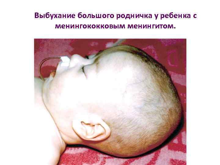 Выбухание большого родничка у ребенка с менингококковым менингитом. 