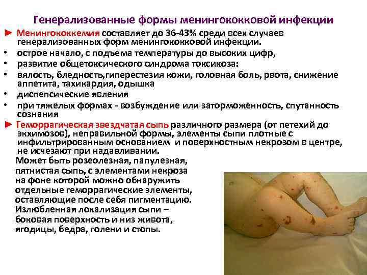 Генерализованные формы менингококковой инфекции ► Менингококкемия составляет до 36 -43% среди всех случаев генерализованных