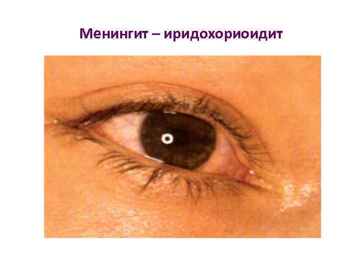 Менингит – иридохориоидит 