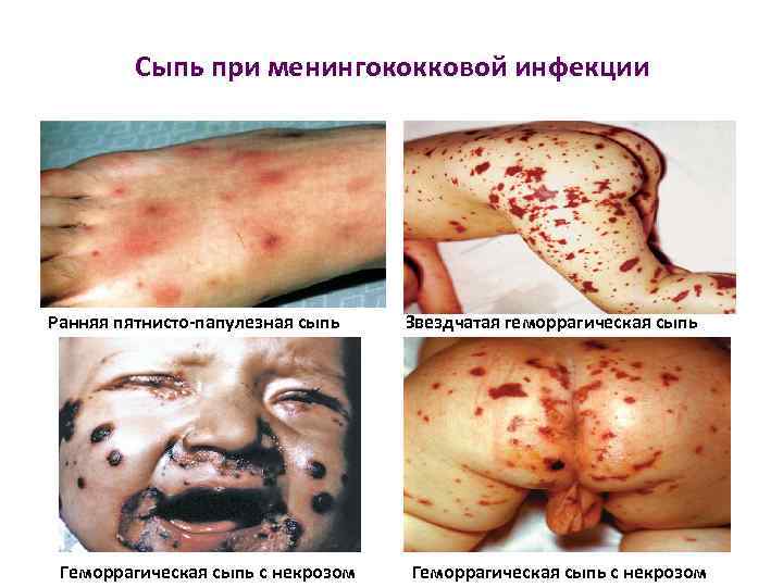 Сыпь при менингококковой инфекции Ранняя пятнисто-папулезная сыпь Геморрагическая сыпь с некрозом Звездчатая геморрагическая сыпь