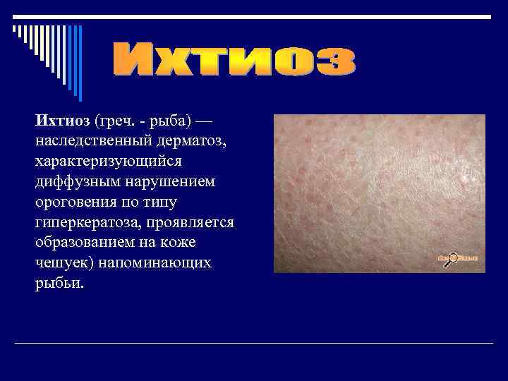 Ихтиоз (греч. - рыба) — наследственный дерматоз, характеризующийся диффузным нарушением ороговения по типу гиперкератоза,