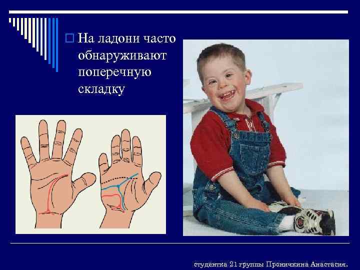 o На ладони часто обнаруживают поперечную складку студентка 21 группы Проничкина Анастасия. 