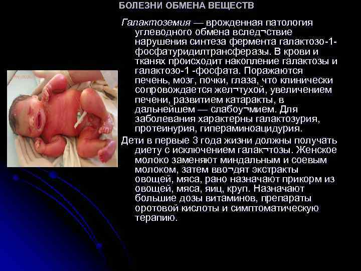 БОЛЕЗНИ ОБМЕНА ВЕЩЕСТВ Галактоземия — врожденная патология углеводного обмена вслед¬ствие нарушения синтеза фермента галактозо-1