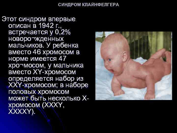 СИНДРОМ КЛАЙНФЕЛГЕРА Этот синдром впервые описан в 1942 г. , встречается у 0, 2%
