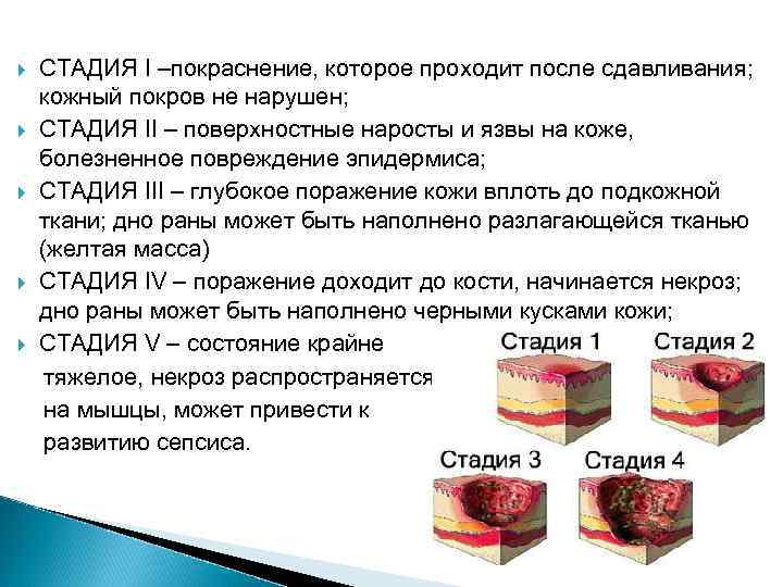 СТАДИЯ І –покраснение, которое проходит после сдавливания; кожный покров не нарушен; СТАДИЯ II –