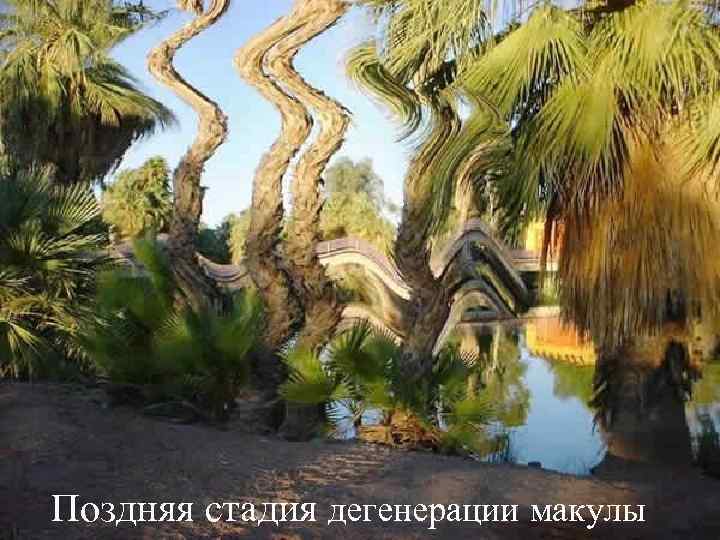 Поздняя стадия дегенерации макулы 