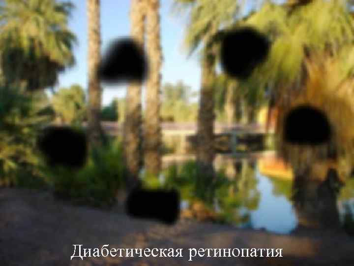 Диабетическая ретинопатия 