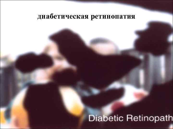диабетическая ретинопатия 