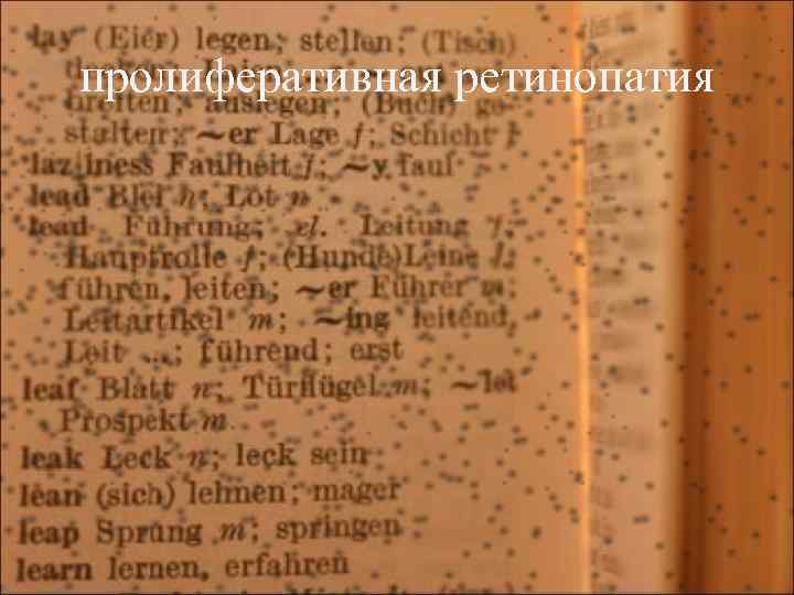 пролиферативная ретинопатия 