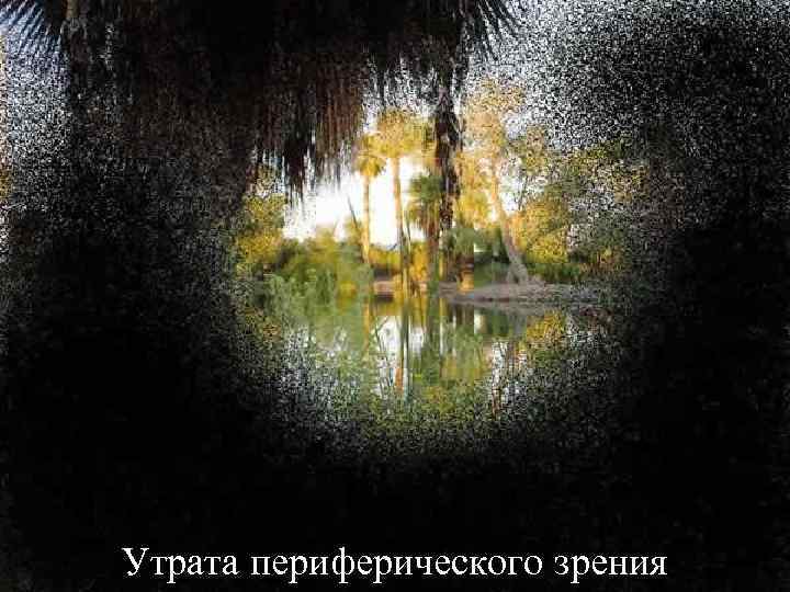 Утрата периферического зрения 