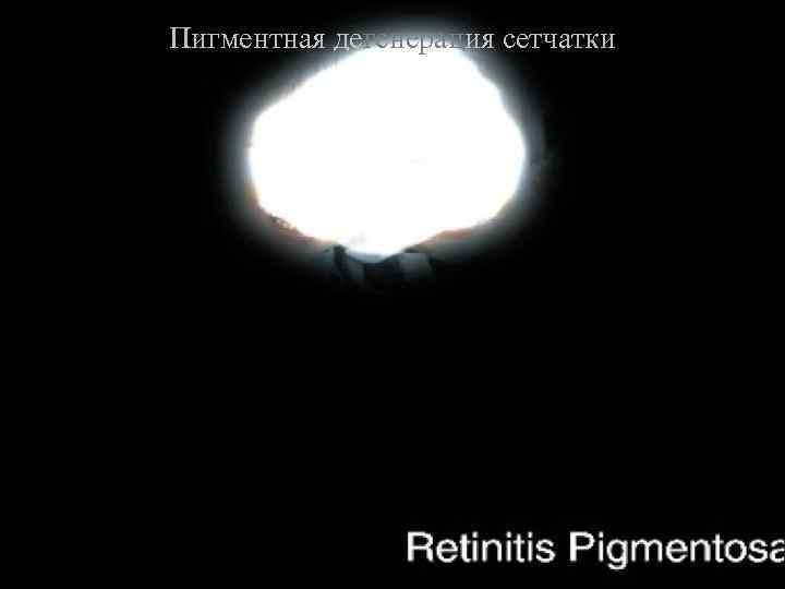 Пигментная дегенерация сетчатки 