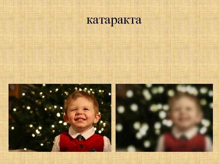 катаракта 