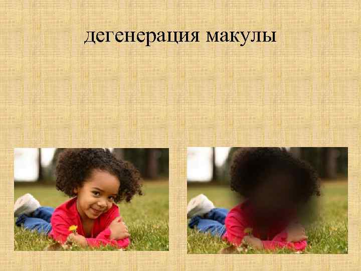 дегенерация макулы 