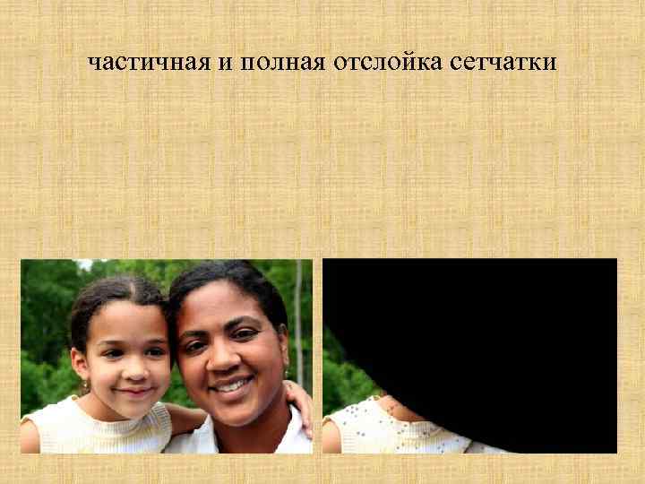 частичная и полная отслойка сетчатки 