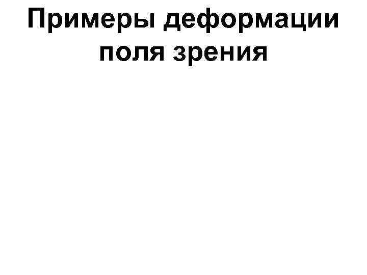 Примеры деформации поля зрения 