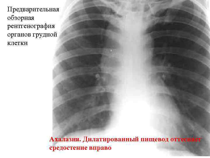 Предварительная обзорная рентгенография органов грудной клетки Ахалазия. Дилатированный пищевод оттесняет средостение вправо 