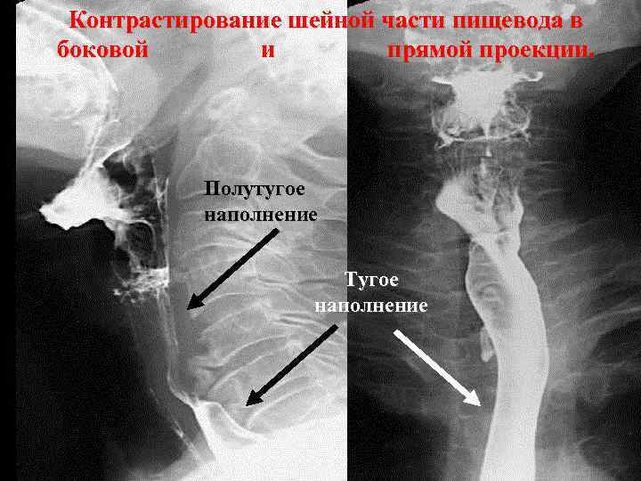 Контрастирование шейной части пищевода в боковой и прямой проекции. Полутугое наполнение Тугое наполнение 