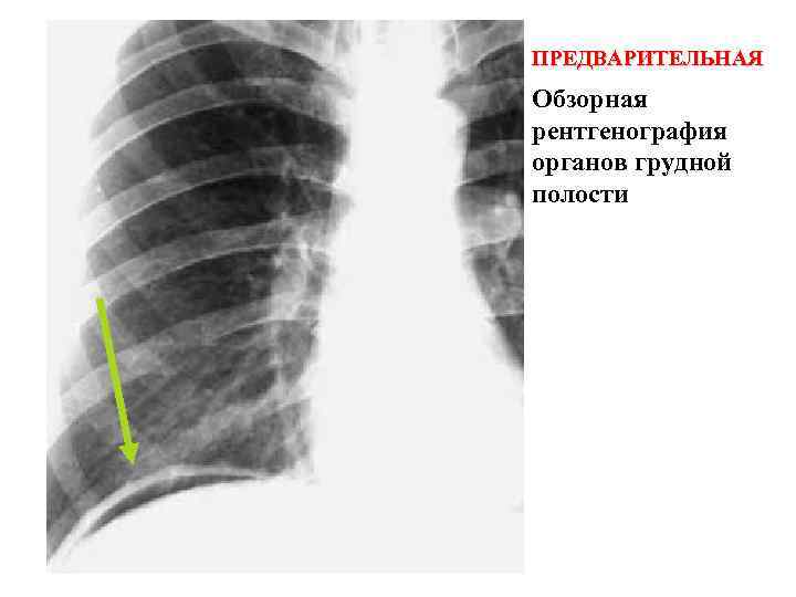 ПРЕДВАРИТЕЛЬНАЯ Обзорная рентгенография органов грудной полости 