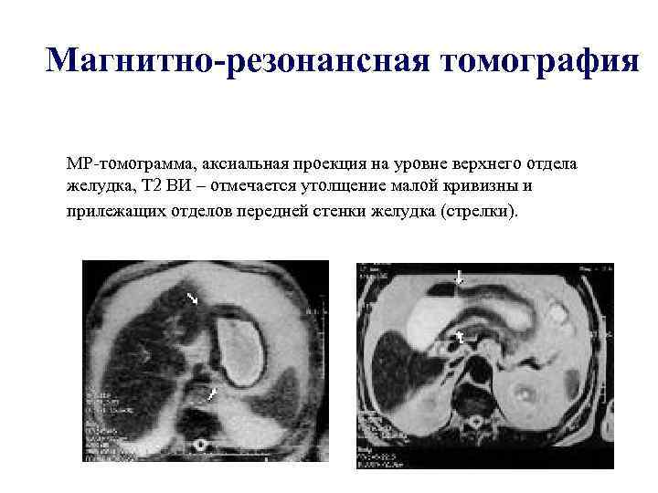 Магнитно-резонансная томография МР-томограмма, аксиальная проекция на уровне верхнего отдела желудка, Т 2 ВИ –