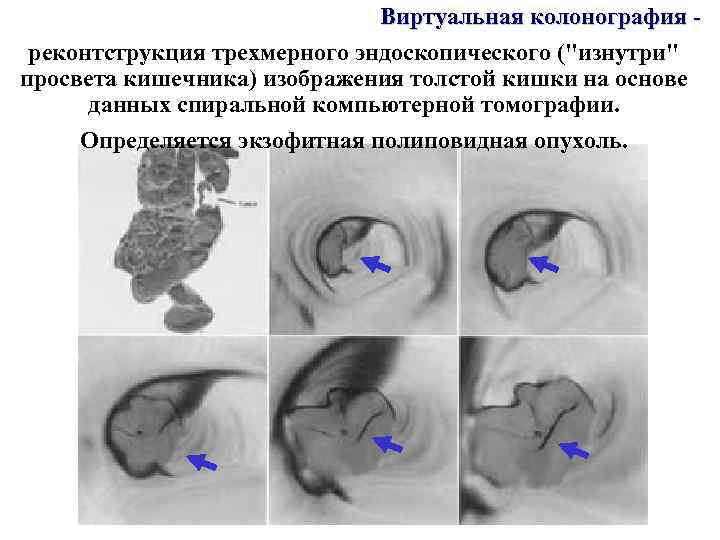 Виртуальная колонография реконтструкция трехмерного эндоскопического (