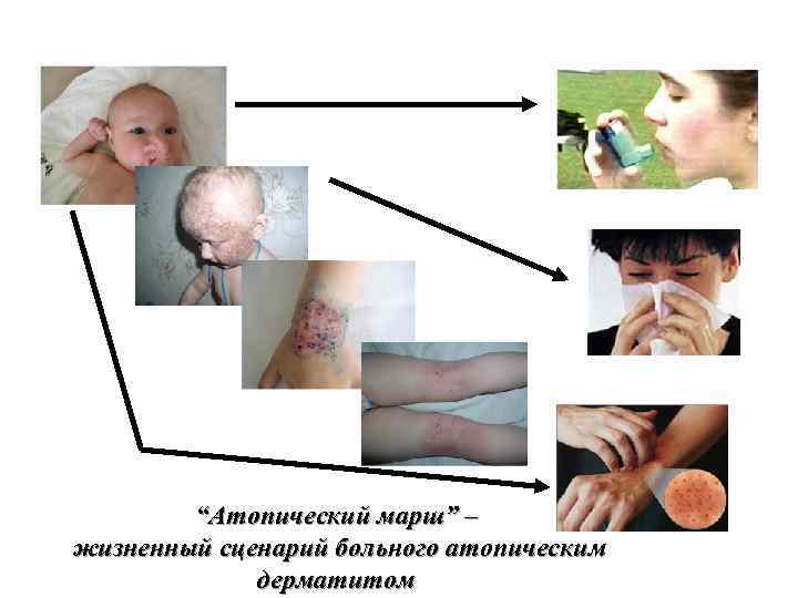 “Атопический марш” – жизненный сценарий больного атопическим дерматитом 