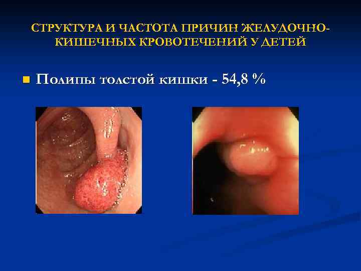 СТРУКТУРА И ЧАСТОТА ПРИЧИН ЖЕЛУДОЧНОКИШЕЧНЫХ КРОВОТЕЧЕНИЙ У ДЕТЕЙ n Полипы толстой кишки - 54,
