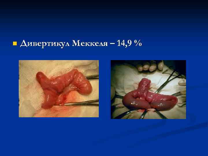 n Дивертикул Меккеля – 14, 9 % 