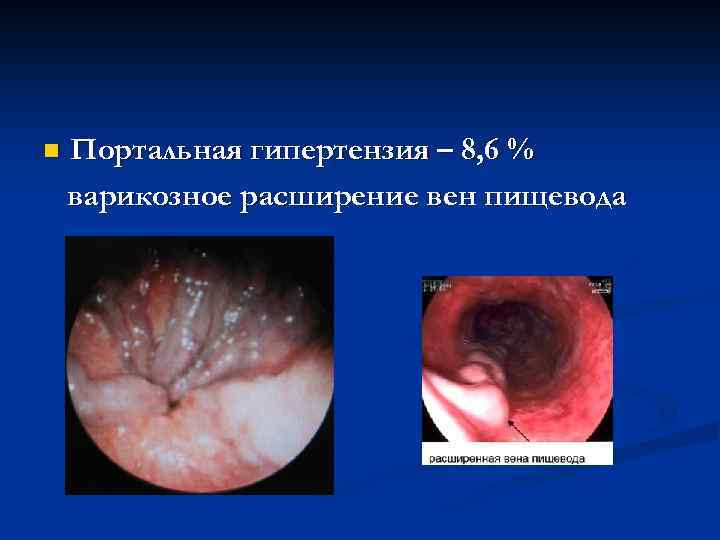 n Портальная гипертензия – 8, 6 % варикозное расширение вен пищевода 