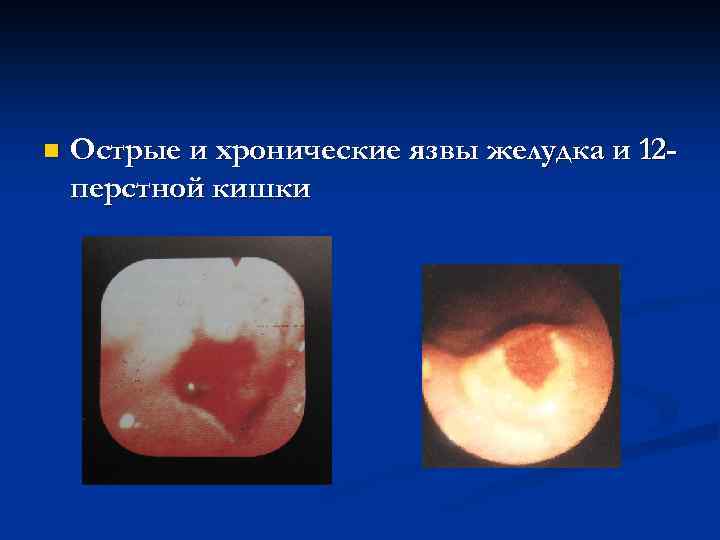 n Острые и хронические язвы желудка и 12 перстной кишки 