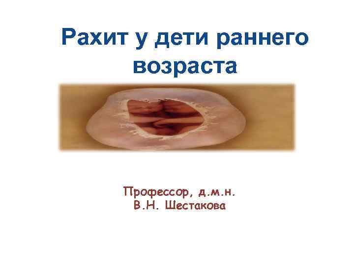 Рахит у дети раннего возраста Профессор, д. м. н. В. Н. Шестакова 