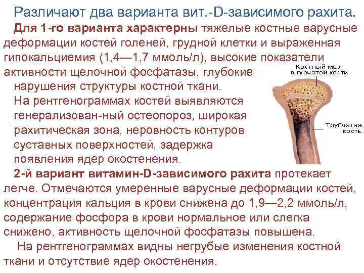 Различают два варианта вит. -D-зависимого рахита. Для 1 -го варианта характерны тяжелые костные варусные