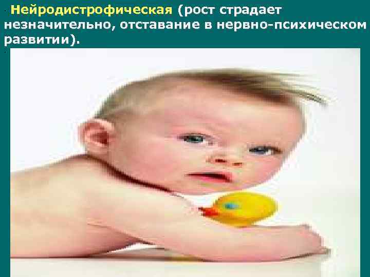 · Нейродистрофическая (рост страдает незначительно, отставание в нервно-психическом развитии). · 
