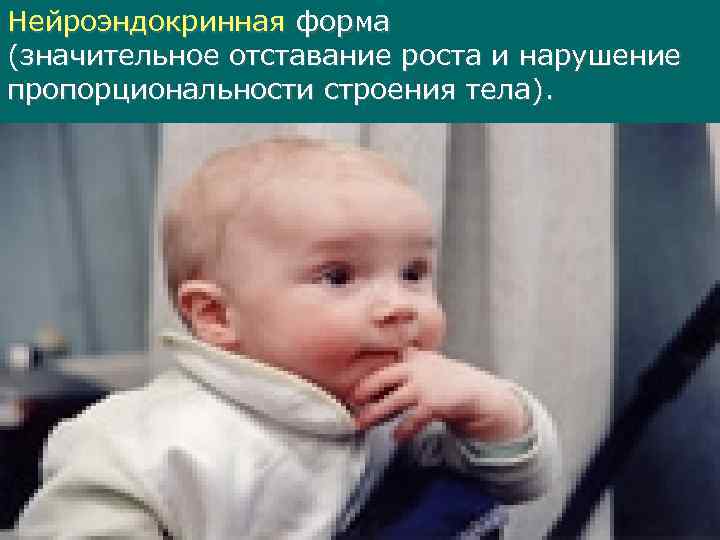 Нейроэндокринная форма (значительное отставание роста и нарушение пропорциональности строения тела). 