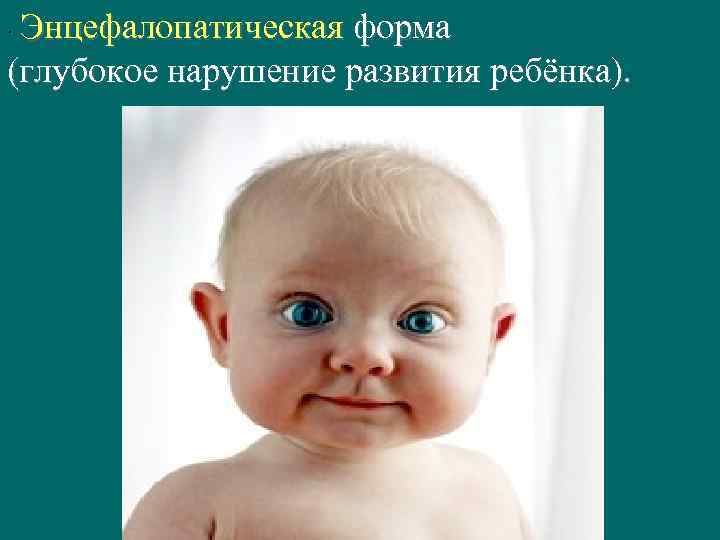 Энцефалопатическая форма (глубокое нарушение развития ребёнка). · 